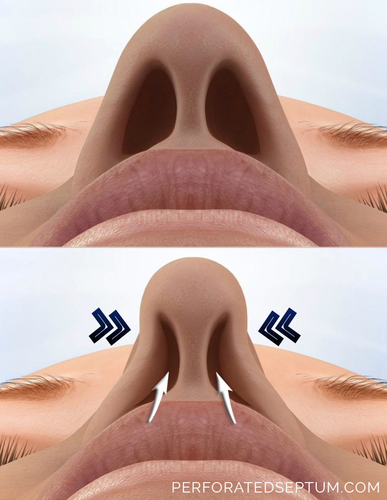 nasal septum perforation surgery