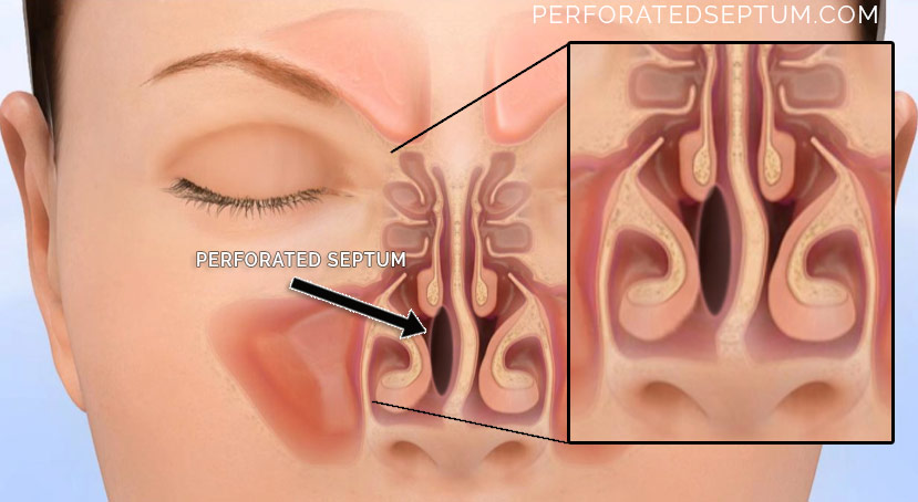 perforated septum surgery