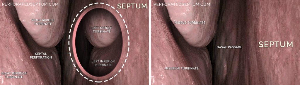 perforated septum surgery los angeles