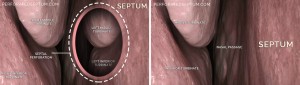 Perforated Septum, Dr. Hamilton - Surgical Repair of a Hole in the Septum