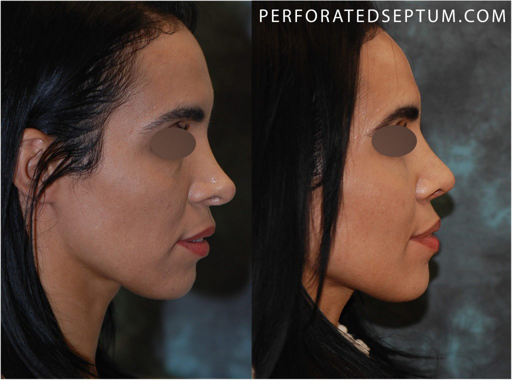 saddle-nose-before-after