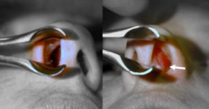 Perforated Septum, Dr. Hamilton - Surgical Repair of a Hole in the Septum