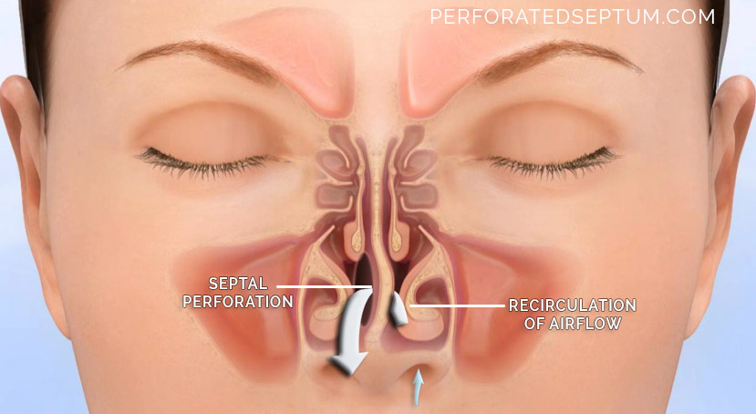 surgery for nose hole