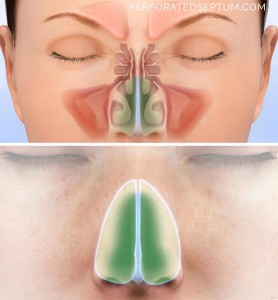 Perforated Septum, Dr. Hamilton - Surgical Repair of a Hole in the Septum