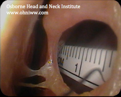 nasal-septum-perforation