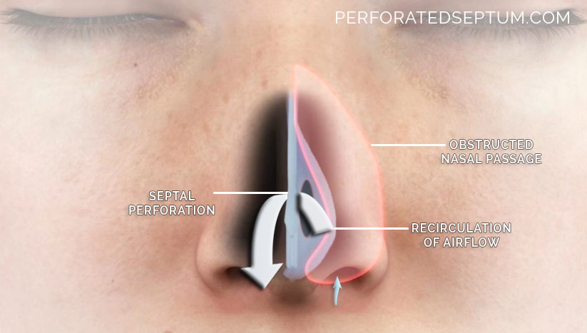 septal perforation surgery