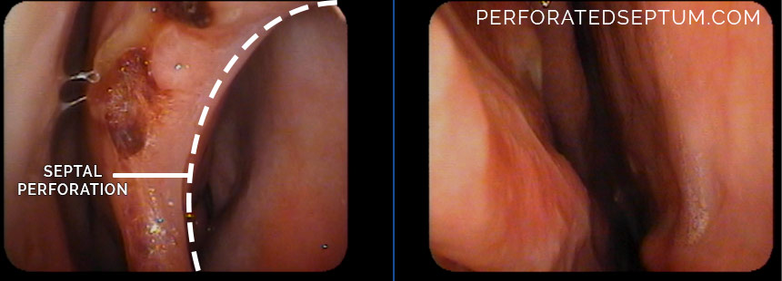 septal perforation treatment los angeles