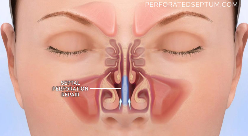 septal perforation correction